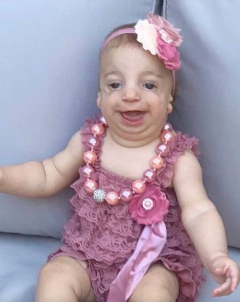 Mom shares touching story of raising a daughter with Treacher Collins Syndrome